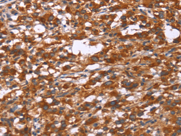 Immunohistochemistry of paraffin-embedded Human thyroid cancer tissue using TA351213 (GPHN Antibody) at dilution 1/30 (Original magnification: x200)