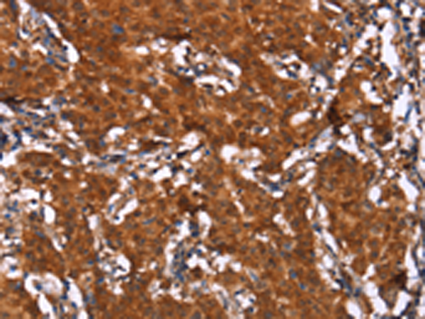 Immunohistochemistry of paraffin-embedded Human gasrtic cancer tissue using TA351228 (HCAR2 Antibody) at dilution 1/40 (Original magnification: x200)