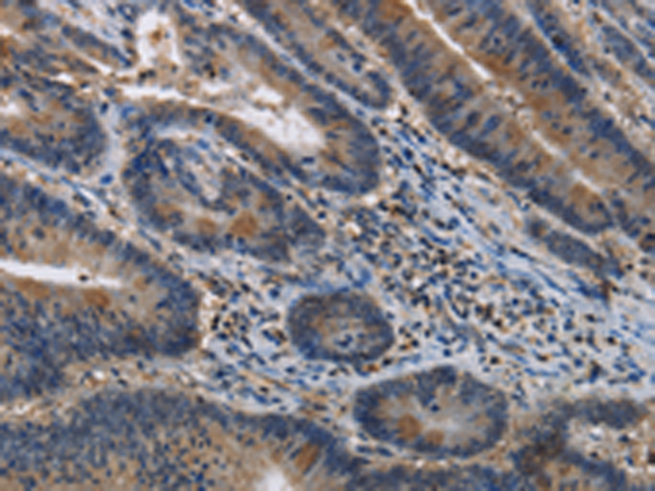 Immunohistochemistry of paraffin-embedded Human colon cancer tissue using TA351305 (ITPR2 Antibody) at dilution 1/40 (Original magnification: x200)