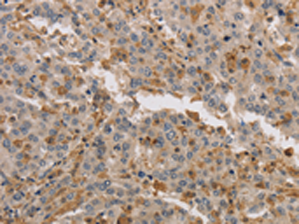 Immunohistochemistry of paraffin-embedded Human liver cancer tissue using TA351327 (KIF17 Antibody) at dilution 1/40 (Original magnification: x200)