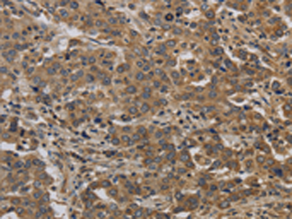 Immunohistochemistry of paraffin-embedded Human liver cancer tissue using TA351329 (KIF4A Antibody) at dilution 1/40 (Original magnification: x200)