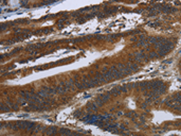 Immunohistochemistry of paraffin-embedded Human colon cancer tissue using TA351340 (ARHGEF12 Antibody) at dilution 1/30 (Original magnification: x200)