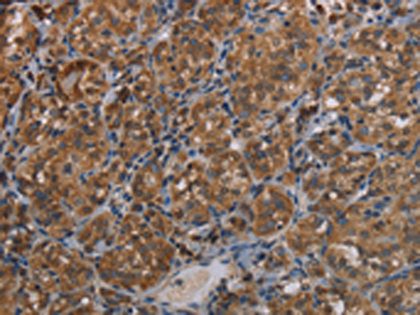 Immunohistochemistry of paraffin-embedded Human thyroid cancer tissue using TA351355 (LLGL1 Antibody) at dilution 1/40 (Original magnification: x200)