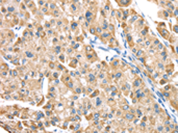 Immunohistochemistry of paraffin-embedded Human liver cancer tissue using TA351366 (LTB4R2 Antibody) at dilution 1/20 (Original magnification: x200)