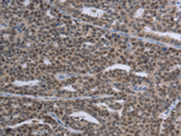 Immunohistochemistry of paraffin-embedded Human ovarian cancer tissue using TA351374 (MAGEC1 Antibody) at dilution 1/30 (Original magnification: x200)