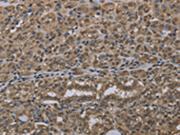 Immunohistochemistry of paraffin-embedded Human thyroid cancer tissue using TA351426 (NLRP6 Antibody) at dilution 1/50 (Original magnification: x200)
