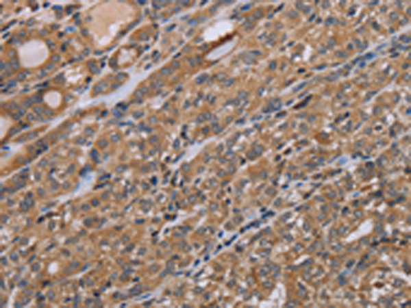 Immunohistochemistry of paraffin-embedded Human thyroid cancer tissue using TA351427 (NAA25 Antibody) at dilution 1/40 (Original magnification: x200)