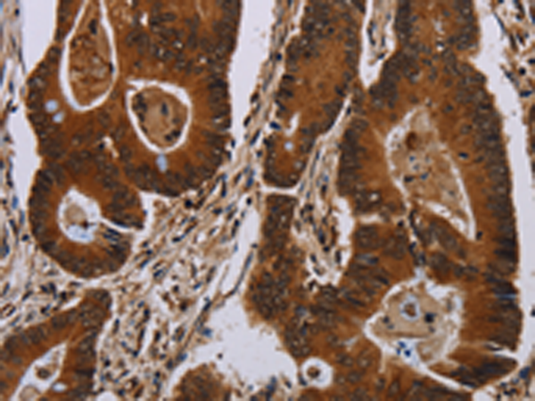 Immunohistochemistry of paraffin-embedded Human colon cancer tissue using TA351465 (DCAF6 Antibody) at dilution 1/50 (Original magnification: x200)