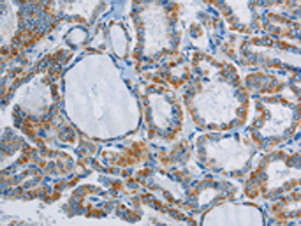 Immunohistochemistry of paraffin-embedded Human thyroid cancer tissue using TA351520 (PPARGC1B Antibody) at dilution 1/40 (Original magnification: x200)