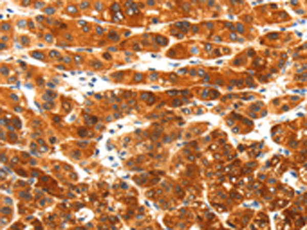Immunohistochemistry of paraffin-embedded Human liver cancer tissue using TA351539 (PLXNA3 Antibody) at dilution 1/25 (Original magnification: x200)