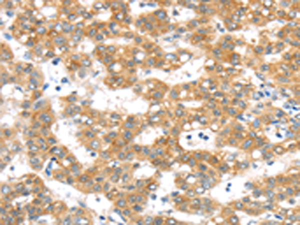Immunohistochemistry of paraffin-embedded Human cervical cancer tissue using TA351566 (PTPN4 Antibody) at dilution 1/40 (Original magnification: x200)