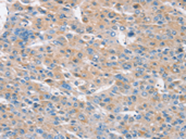 Immunohistochemistry of paraffin-embedded Human liver cancer tissue using TA351585 (RASA3 Antibody) at dilution 1/30 (Original magnification: x200)