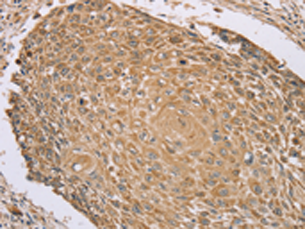 Immunohistochemistry of paraffin-embedded Human lung cancer tissue using TA351603 (RNF148 Antibody) at dilution 1/45 (Original magnification: x200)