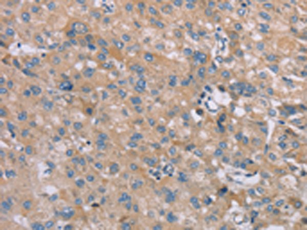 Immunohistochemistry of paraffin-embedded Human liver cancer tissue using TA351623 (SAMD9 Antibody) at dilution 1/35 (Original magnification: x200)