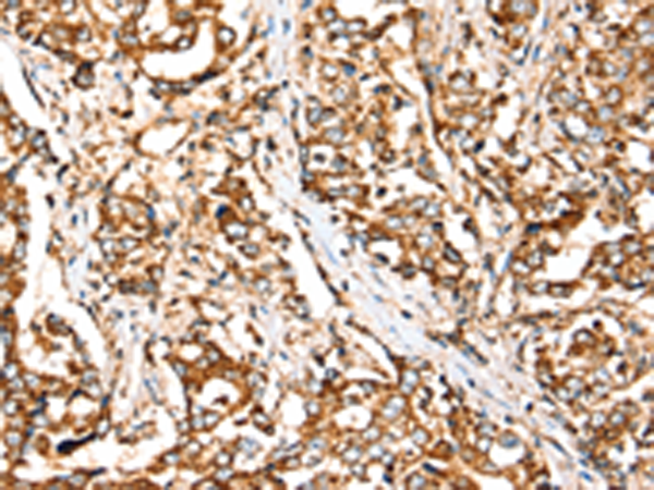 Immunohistochemistry of paraffin-embedded Human liver cancer tissue using TA351668 (SIGLEC11 Antibody) at dilution 1/30 (Original magnification: x200)