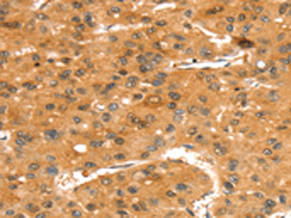 Immunohistochemistry of paraffin-embedded Human liver cancer tissue using TA351683 (SLC24A4 Antibody) at dilution 1/35 (Original magnification: x200)