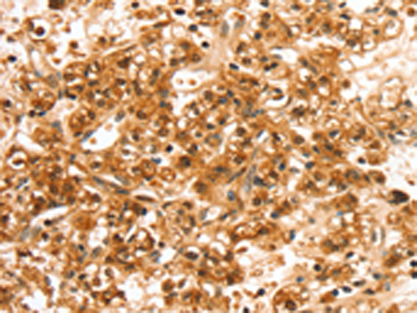 Immunohistochemistry of paraffin-embedded Human prostate cancer tissue using TA351704 (SLC44A2 Antibody) at dilution 1/20 (Original magnification: x200)