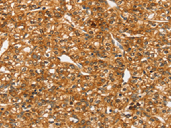 Immunohistochemistry of paraffin-embedded Human prostate cancer tissue using TA351705 (SLC4A7 Antibody) at dilution 1/25 (Original magnification: x200)
