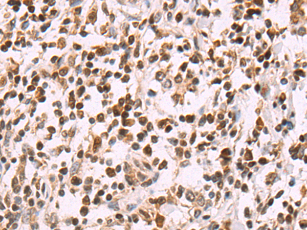 Immunohistochemistry of paraffin-embedded Human gastric cancer tissue using TA351723 (SLTM Antibody) at dilution 1/50 (Original magnification: x200)