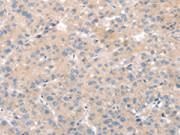 Immunohistochemistry of paraffin-embedded Human liver cancer tissue using TA351738 (SNX29 Antibody) at dilution 1/30 (Original magnification: x200)