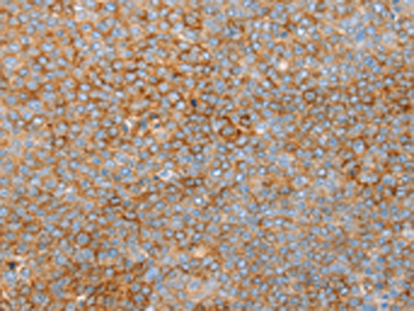 Immunohistochemistry of paraffin-embedded Human ovarian cancer tissue using TA351740 (SNX33 Antibody) at dilution 1/25 (Original magnification: x200)