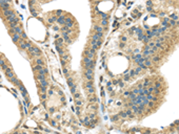 Immunohistochemistry of paraffin-embedded Human thyroid cancer tissue using TA351762 (STK35 Antibody) at dilution 1/45 (Original magnification: x200)