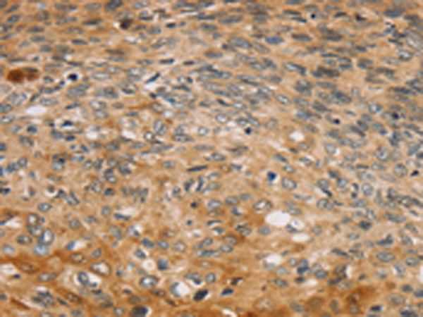 Immunohistochemistry of paraffin-embedded Human esophagus cancer tissue using TA351792 (TBC1D21 Antibody) at dilution 1/30 (Original magnification: x200)
