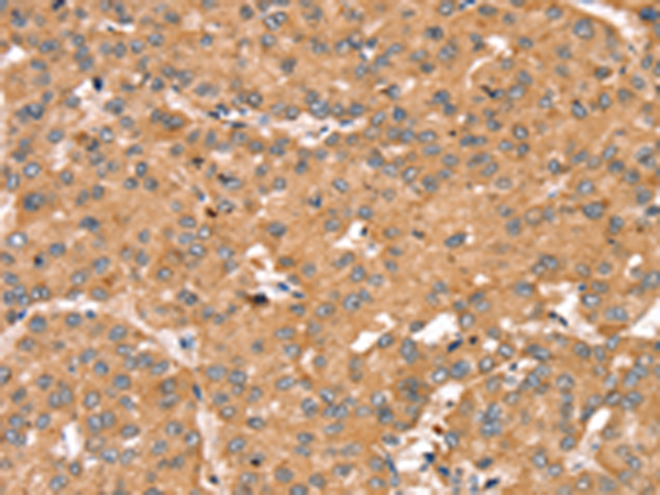 Immunohistochemistry of paraffin-embedded Human liver cancer tissue using TA351808 (TRIM14 Antibody) at dilution 1/35 (Original magnification: x200)