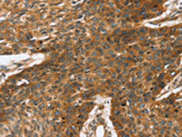 Immunohistochemistry of paraffin-embedded Human esophagus cancer tissue using TA351861 (TRPV5 Antibody) at dilution 1/35 (Original magnification: x200)