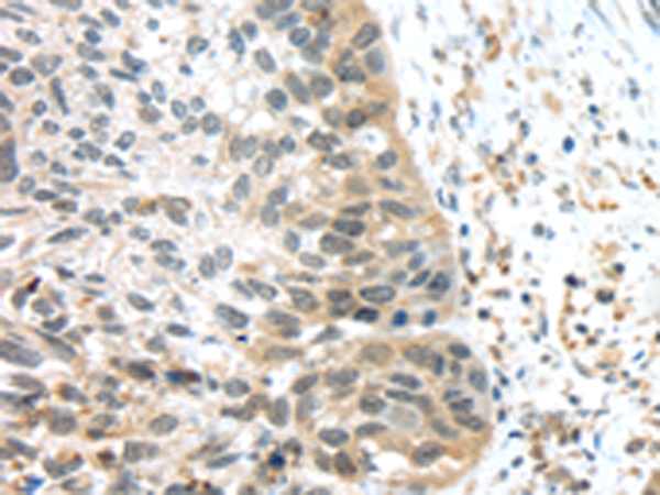 Immunohistochemistry of paraffin-embedded Human esophagus cancer tissue using TA351868 (TSPY1/TSPY3 Antibody) at dilution 1/45 (Original magnification: x200)