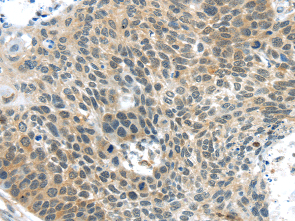 Immunohistochemistry of paraffin-embedded Human esophagus cancer tissue using TA351869 (TSPY1 Antibody) at dilution 1/40 (Original magnification: x200)