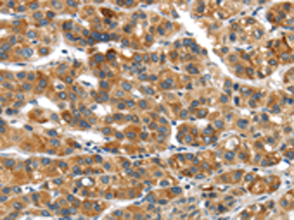 Immunohistochemistry of paraffin-embedded Human liver cancer tissue using TA351882 (UBAP2 Antibody) at dilution 1/20 (Original magnification: x200)