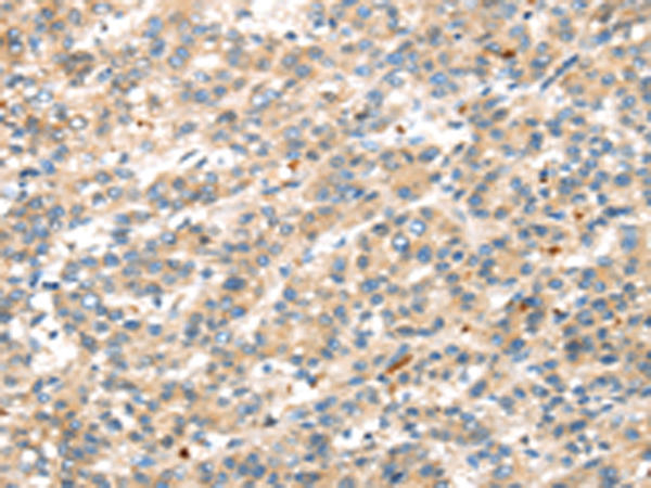 Immunohistochemistry of paraffin-embedded Human liver cancer tissue using TA351888 (DKK1 Antibody) at dilution 1/35 (Original magnification: x200)