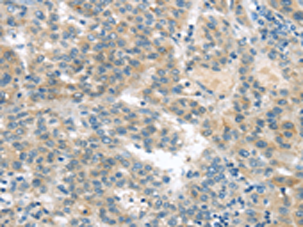 Immunohistochemistry of paraffin-embedded Human liver cancer tissue using TA351911 (VAV2 Antibody) at dilution 1/20 (Original magnification: x200)