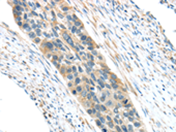 Immunohistochemistry of paraffin-embedded Human esophagus cancer tissue using TA351921 (VWCE Antibody) at dilution 1/30 (Original magnification: x200)