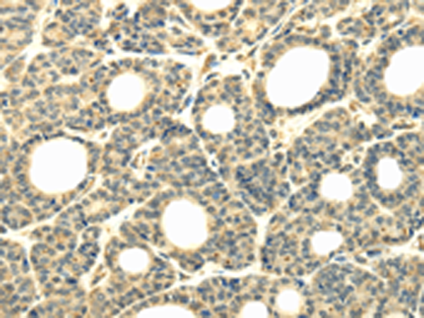 Immunohistochemistry of paraffin-embedded Human thyroid cancer tissue using TA351926 (WDR45B Antibody) at dilution 1/40 (Original magnification: x200)