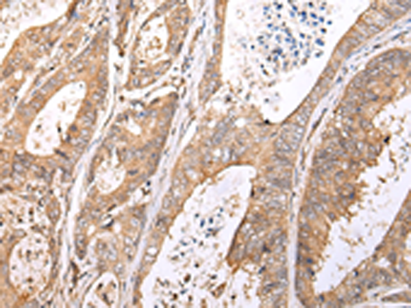 Immunohistochemistry of paraffin-embedded Human colorectal cancer tissue using TA351962 (XKR7 Antibody) at dilution 1/20 (Original magnification: x200)