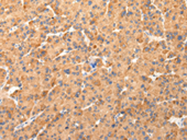Immunohistochemistry of paraffin-embedded Human liver cancer tissue using TA351992 (AQP7 Antibody) at dilution 1/40 (Original magnification: x200)