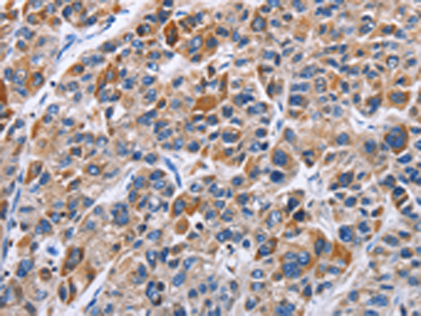Immunohistochemistry of paraffin-embedded Human liver cancer tissue using TA364459 (ENPP5 Antibody) at dilution 1/40 (Original magnification: x200)