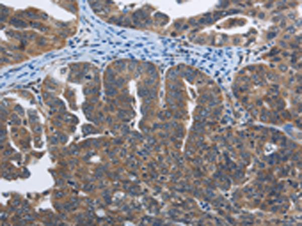 Immunohistochemistry of paraffin-embedded Human ovarian cancer tissue using TA364559 (SYT3 Antibody) at dilution 1/40 (Original magnification: x200)