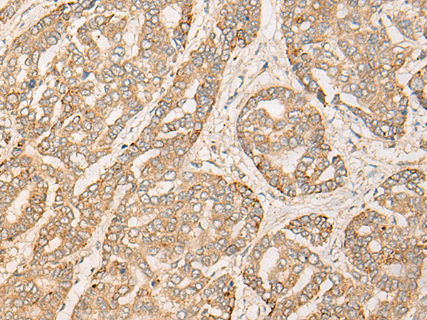 Immunohistochemistry of paraffin-embedded Human liver cancer tissue using TA364573 (VPS18 Antibody) at dilution 1/25. (Original magnification: x200)