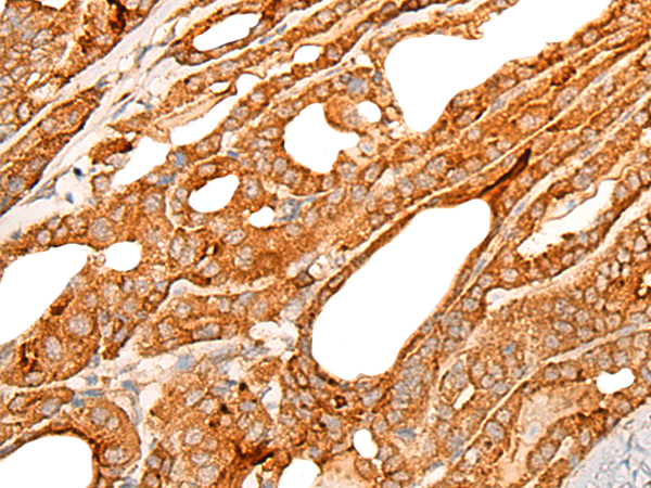 Formalin-paraffin human melanoma stained with Vimentin Antibody (Clone VM452).