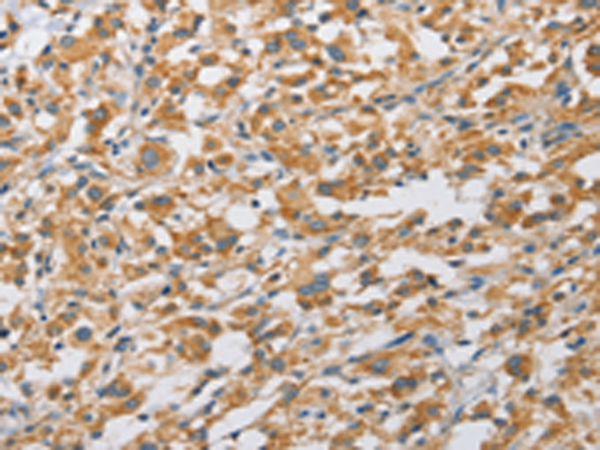 Immunohistochemistry of paraffin-embedded Human thyroid cancer tissue using TA364608 (ARHGAP5 Antibody) at dilution 1/25 (Original magnification: x200)