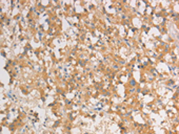 Immunohistochemistry of paraffin-embedded Human thyroid cancer tissue using TA364619 (ART3 Antibody) at dilution 1/40 (Original magnification: x200)