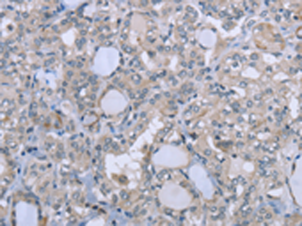 Formalin-Fixed, Paraffin-Embedded colon cancer stained with TAG72 Antibody Cat.-No AM33278PU (Clone SPM148). Note cytoplasmic and cell surface staining.