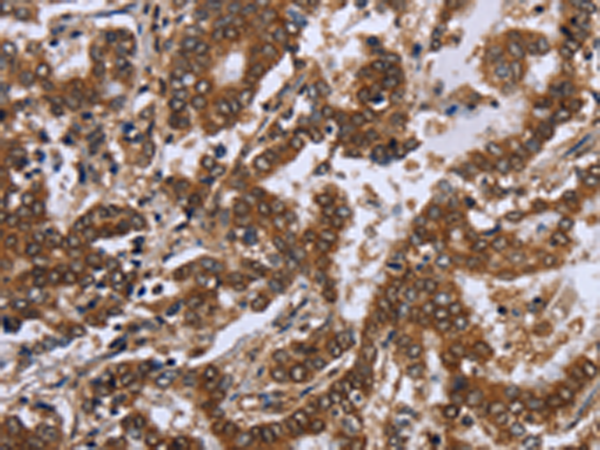 Formalin-Fixed, Paraffin-Embedded colon cancer stained with TAG72 Antibody Cat.-No AM33279PU (Clone SPM536). Note cytoplasmic and cell surface staining.