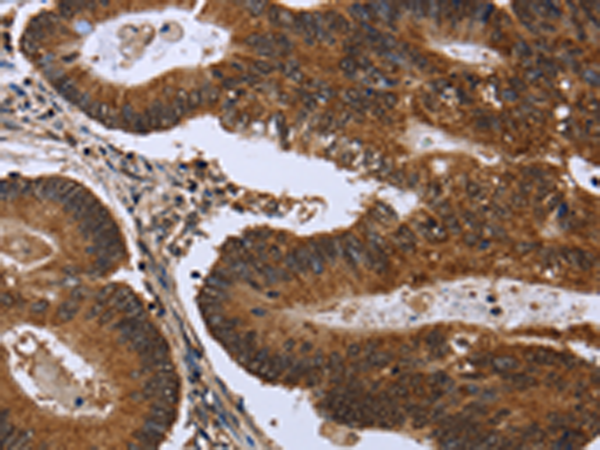 Formalin-Fixed, Paraffin-Embedded colon cancer stained with TAG72 Antibody Cat.-No AM33279PU (Clone SPM536). Note cytoplasmic and cell surface staining.