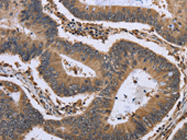 Formalin-paraffin Human Hepatocell ular Carcinoma stained with HSA Antibody Cat.-No AM33286PU (Clone SPM582).