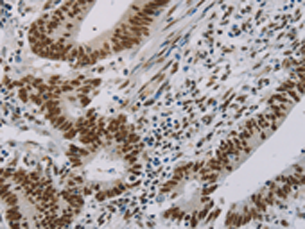Formalin-Paraffin colon cancer stained withTAG72 Antibody Cat.-No AM33342PU (Clone B72.3+CC49). Note cytoplasmic and cell surface staining.