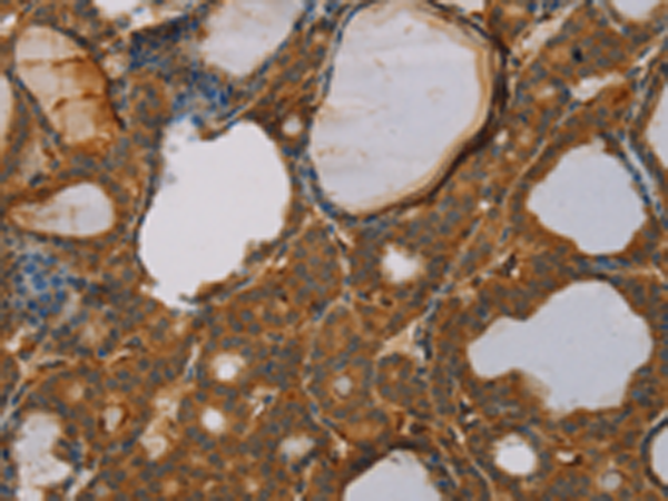Immunohistochemistry of paraffin-embedded Human thyroid cancer tissue using TA364910 (PAGE2 Antibody) at dilution 1/20 (Original magnification: x200)
